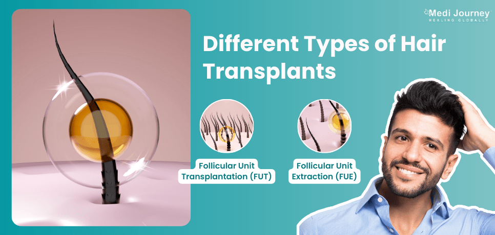 Types of Hair Transplants