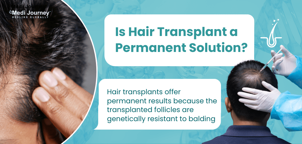 Is hair transplant a permanent solution?